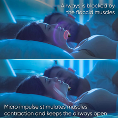 Parche Inteligente Antironquidos con Pulsos Duales AI